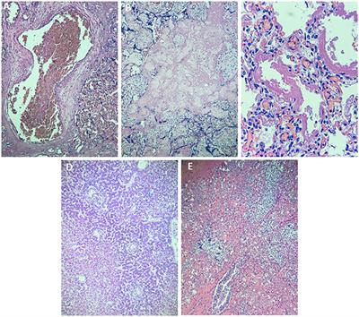 Case Report: Placental Maternal Vascular Malperfusion Affecting Late Fetal Development and Multiorgan Infection Caused by SARS-CoV-2 in Patient With PAI-1 4G/5G Polymorphism